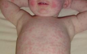 Alergická vyrážka u dětí